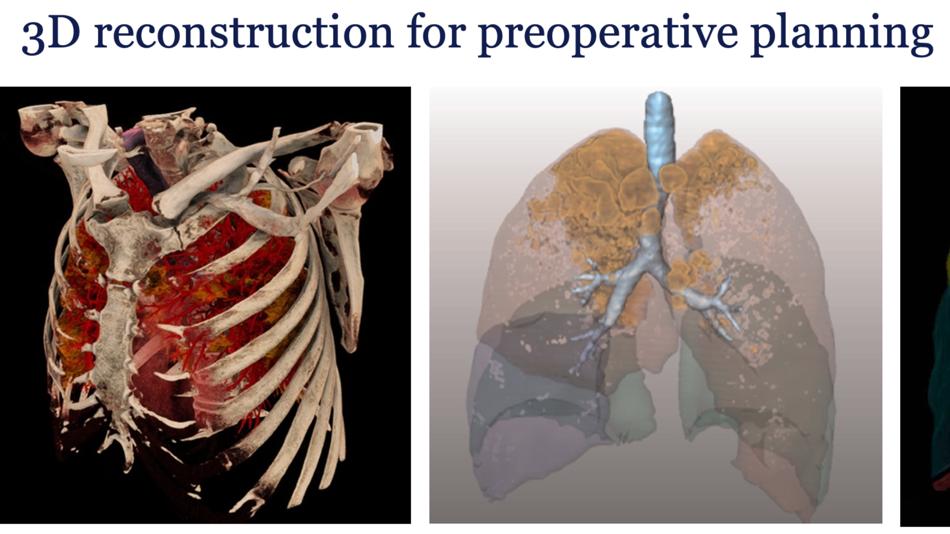 [LNF26] Anatomische Segmentresektion der Lunge – Planung und Operation